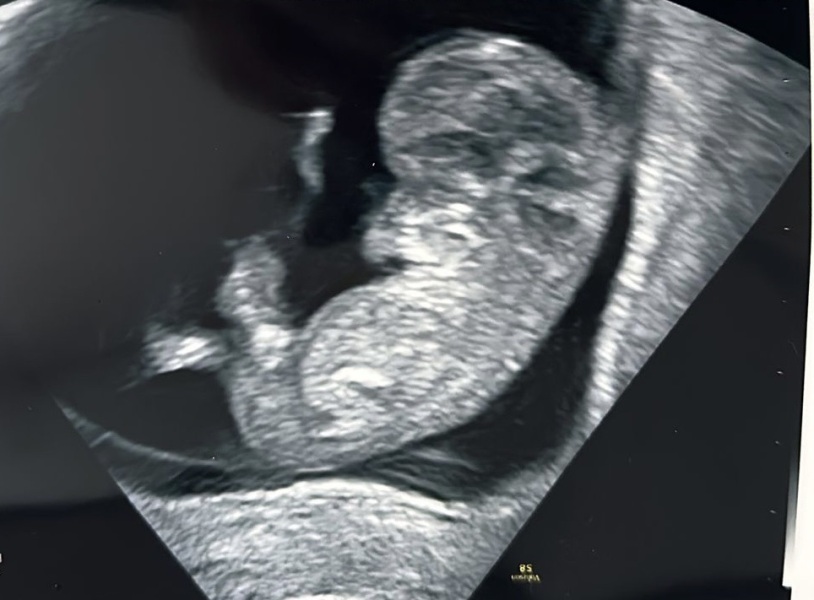 Preganncy