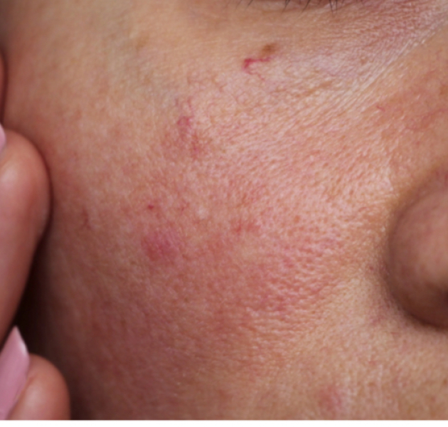 How to get rid of rosacea?