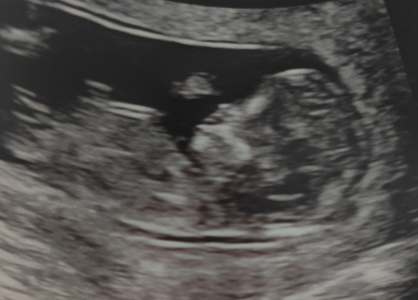 Nub before gender scan!