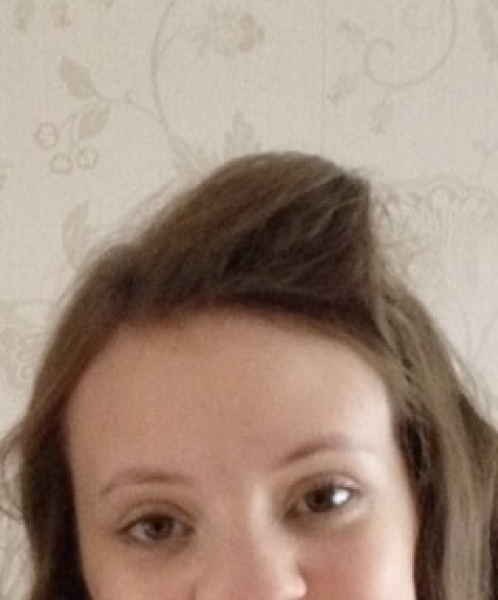 Worried about 1 year old daughters hairline