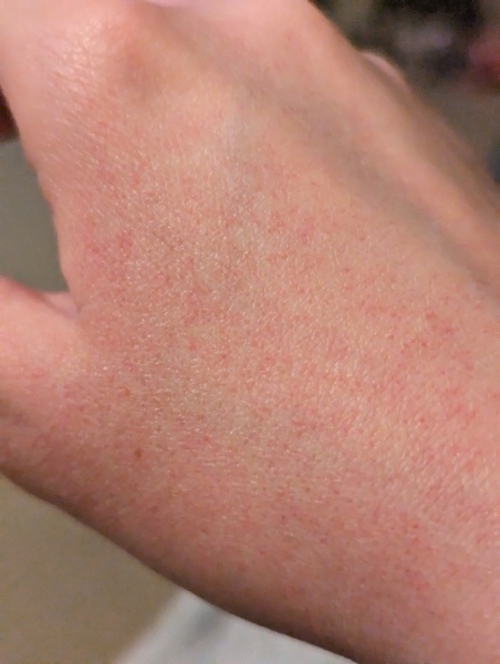 Tingly achy rash???