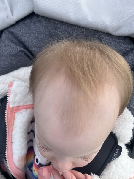 Worried about 1 year old daughters hairline
