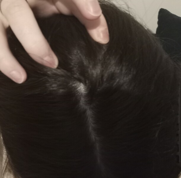 Dent in my skull painful
