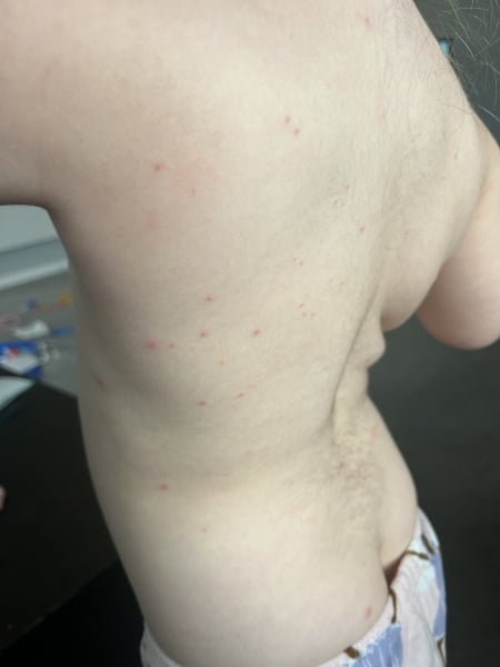 Chicken pox or MMR vaccine reaction?