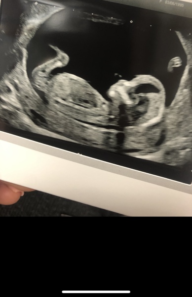 Boy or girl? Nub theory?