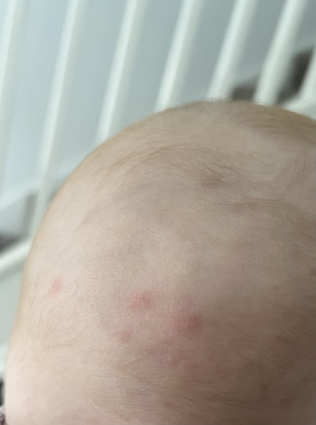 3 red raised bumps back of babies hear