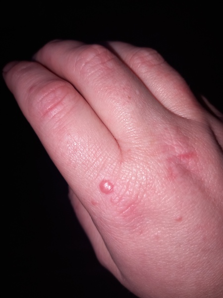 Bumps/blisters on hands