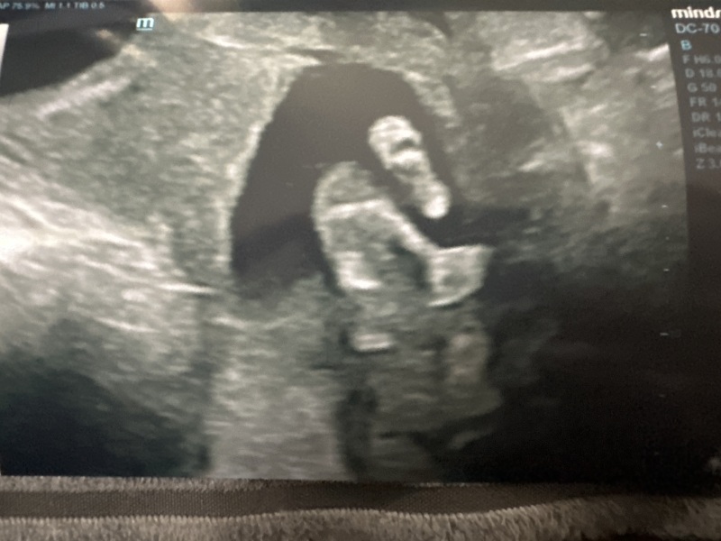 Scan picture inbetween the legs! Boy or girl?