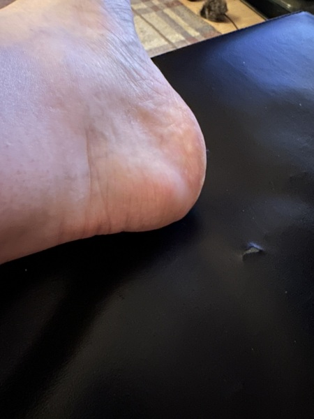 Lump appeared next to Achilles