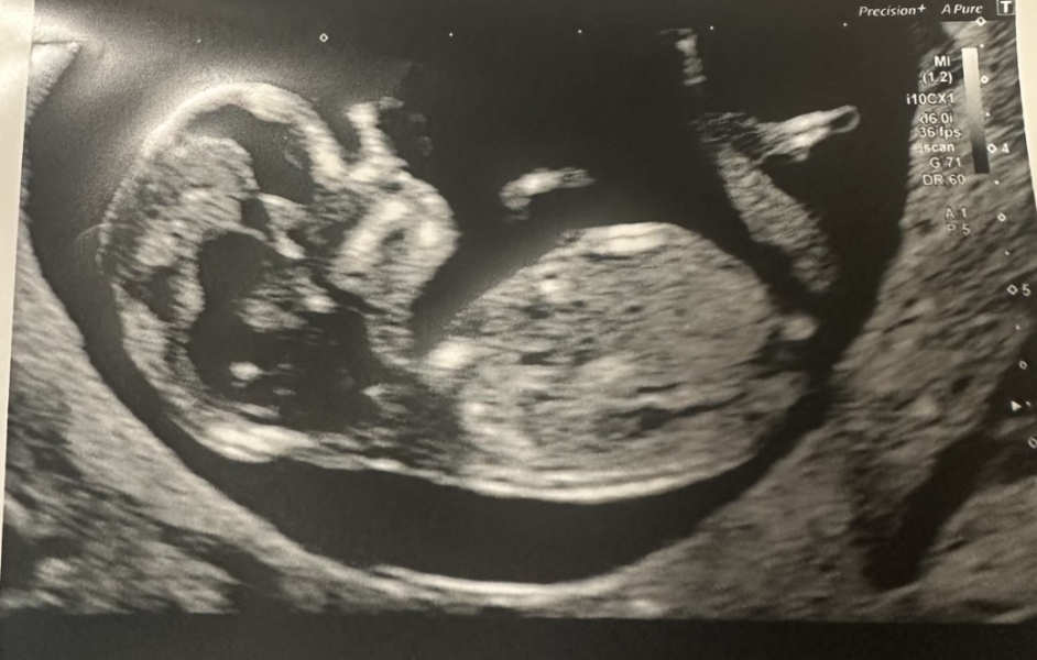 Nub theory - boy or girl? 12 wks 2 days
