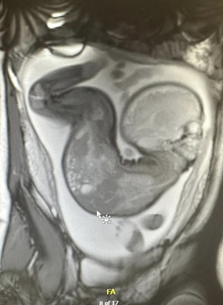 Hyperextension of fetal neck and spine