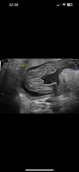 Boy or girl
