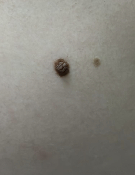 Melanoma??