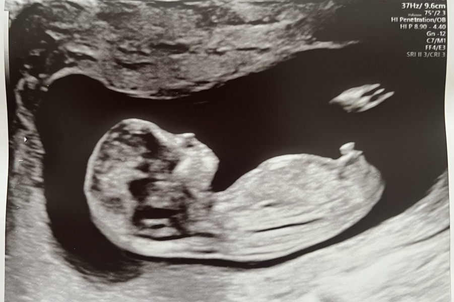 12 Week Scan Anxiety