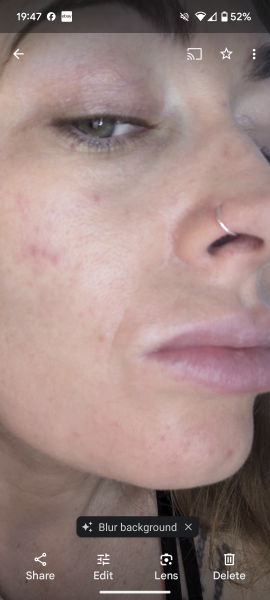 Facial Redness/Skin uneveness