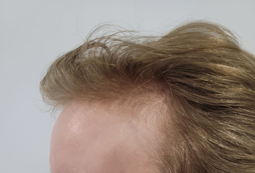I’ve just had a hair transplant AMA