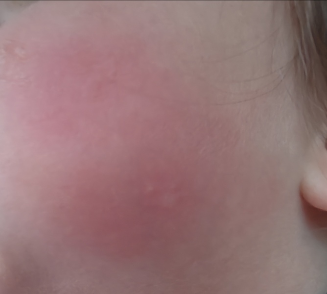 Rash photos - measles at nursery