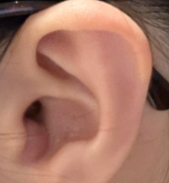 Is my cyst giving me a fever? (Pic included — do not click if you don't want to see an ear cyst)