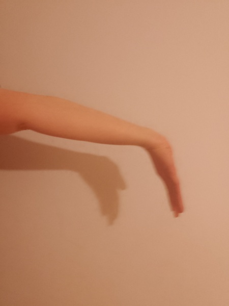 Hypermobility - when did you know