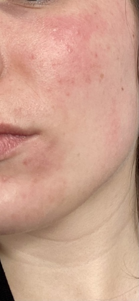 Is this Rosacea? So sore, tight and flaky
