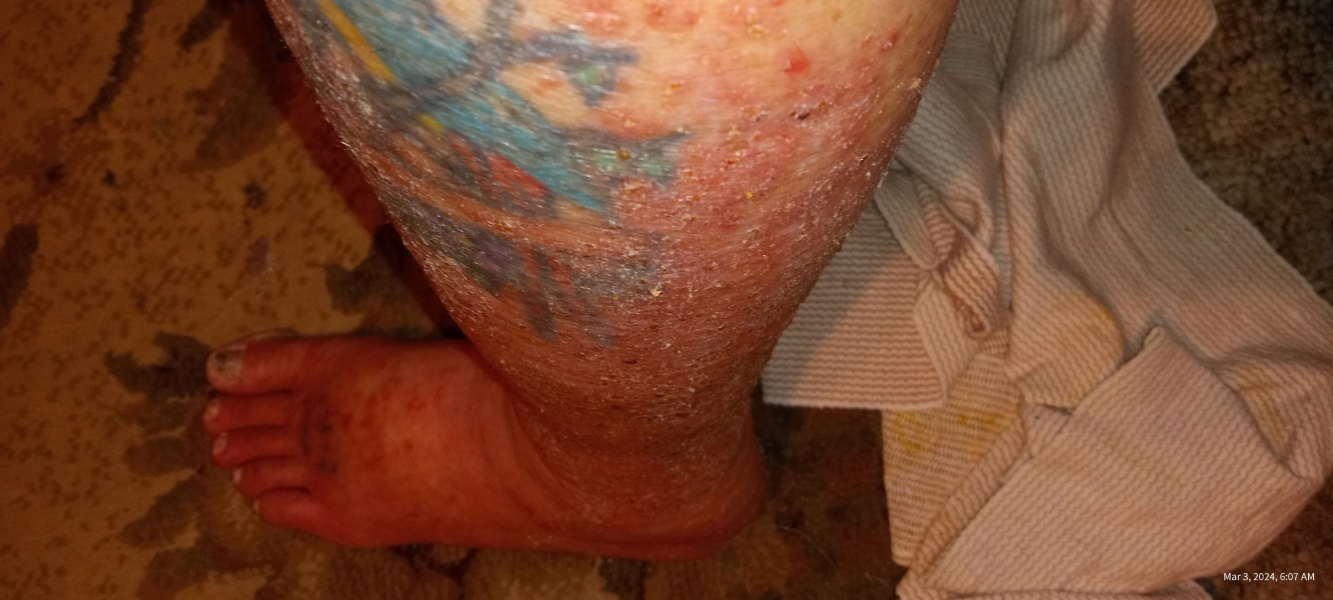 Is this shingles? 