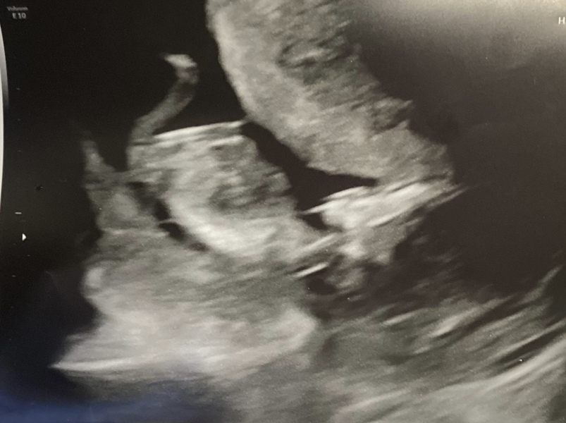 12 week scan.. boy or girl??