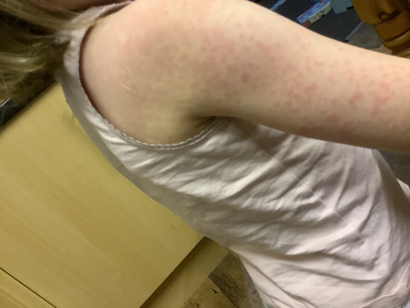Scarlet Fever any tips?