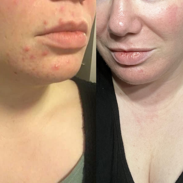 Another acne one