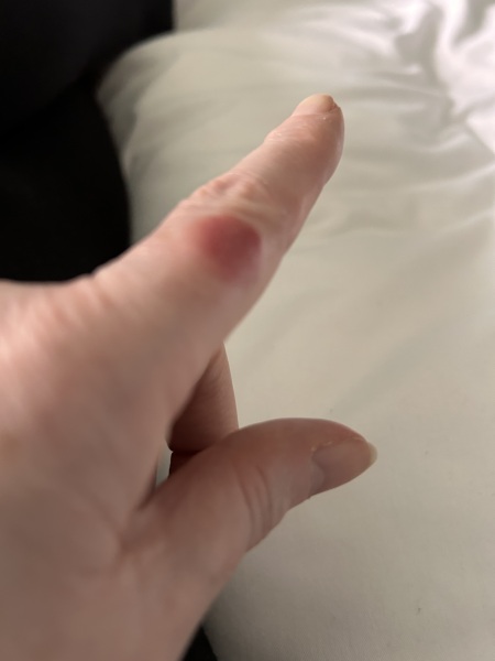 Boil or insect bite?