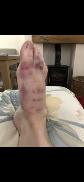 To not worry about my manky foot (horrible pic included)