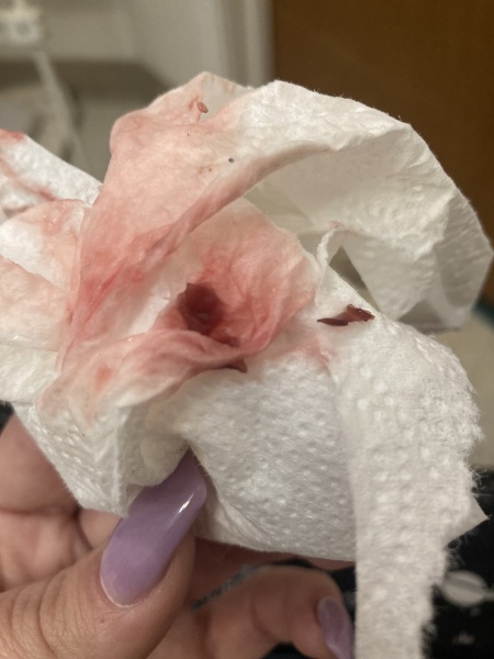 (TRIGGER WARNING PICTURE) Am I having a miscarriage? (