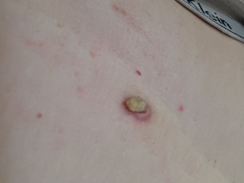 Waiting for Biopsy results cutaneous horn
