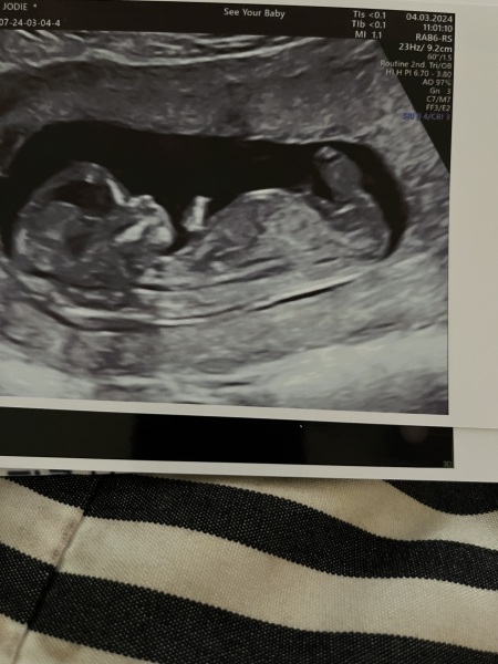 Anyone into nub theory and feeling very kind?? 12 week scan