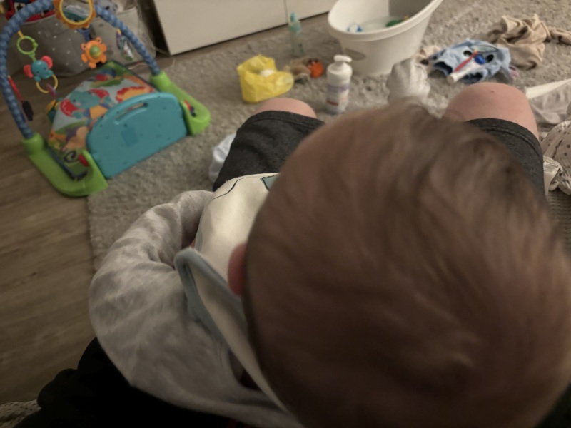 How severe is this plagiocephaly?