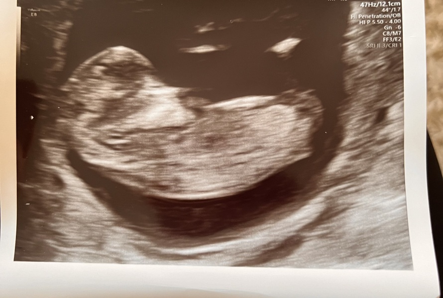 Nub theory- boy or girl?