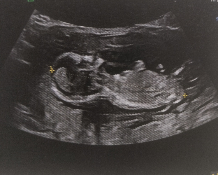 Boy or girl
