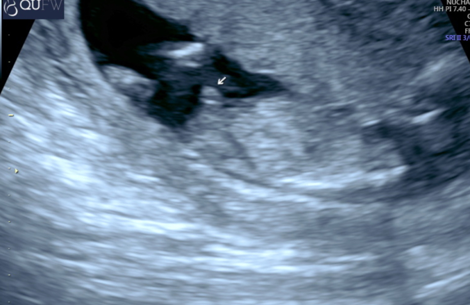 Gender prediction at 12 week scan