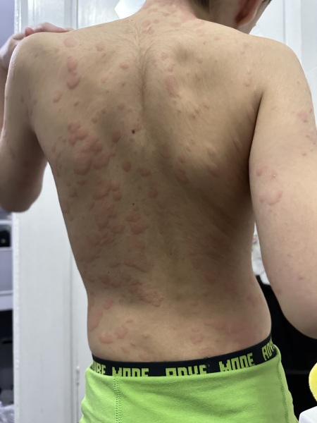 8 year old suddenly came out in hives yesterday, now it’s happened again