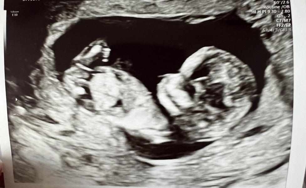 Boy or girl scan guess