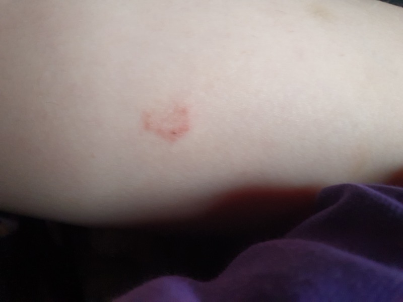 To blame DH for ringworm and jock itch?