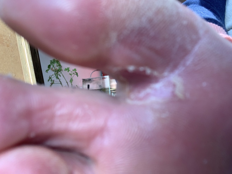 Any dermatologists on to advise? TMI warning - yucky foot photos.