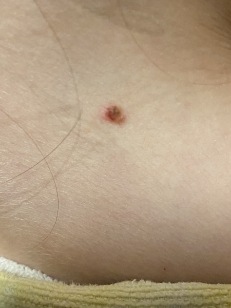 Worried about mole on DD… pic attached!