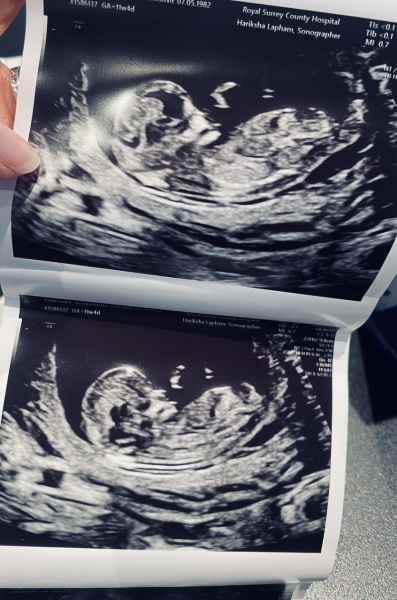 12 week scan - boy or girl?