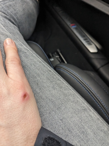 Help- do I need antibiotics for this?