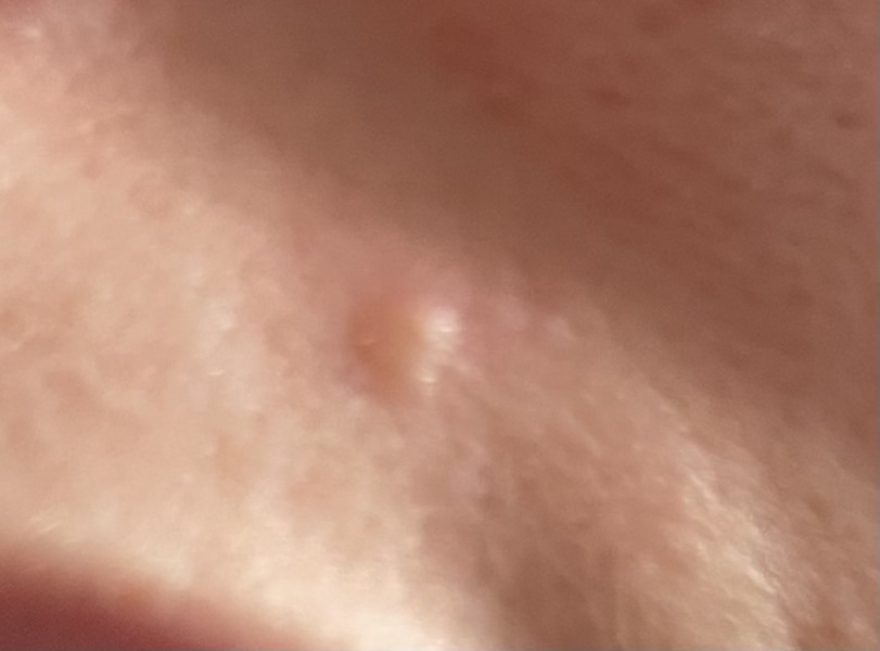 What should I do about this bump? (Pic attached)