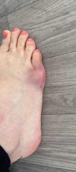 Hurt foot or bunion?
