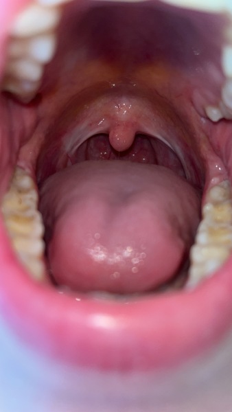 Back of throat white??