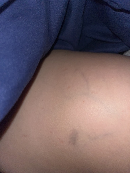 7 year old bruise with blue veins on back after injury