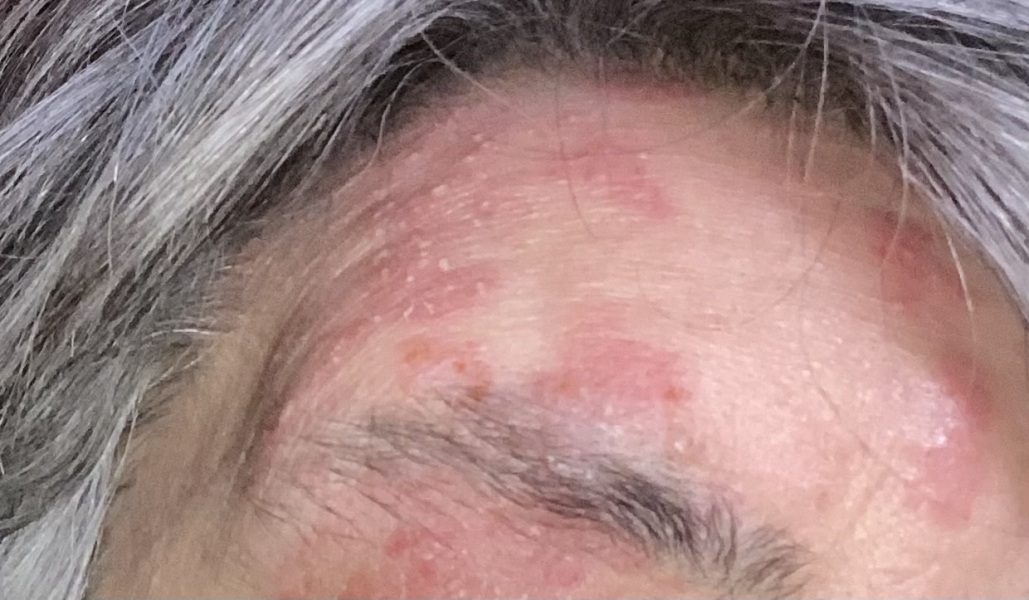 Shingles?