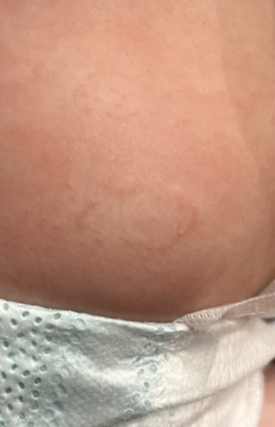 What is this rash?
